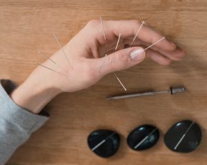 Acupunctura: ajutor în renunțarea la fumat