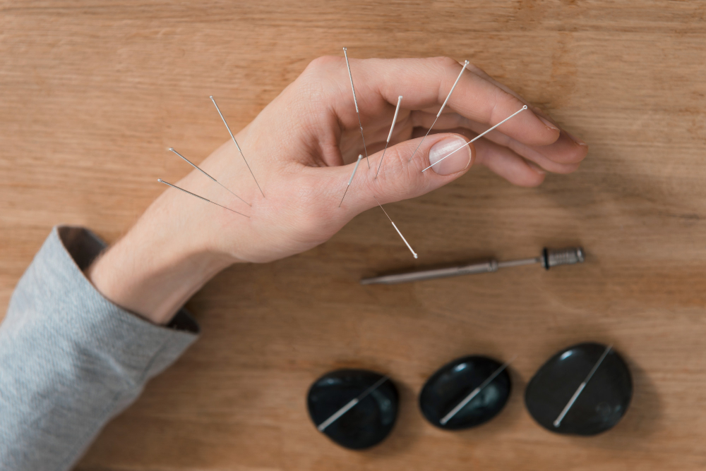 Acupunctura