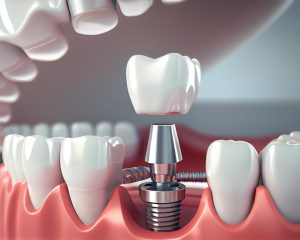 Implantul dentar: Realitatea din spatele mitului