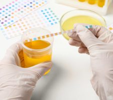 Decodarea culoarei urinei: Indicatori de sănătate